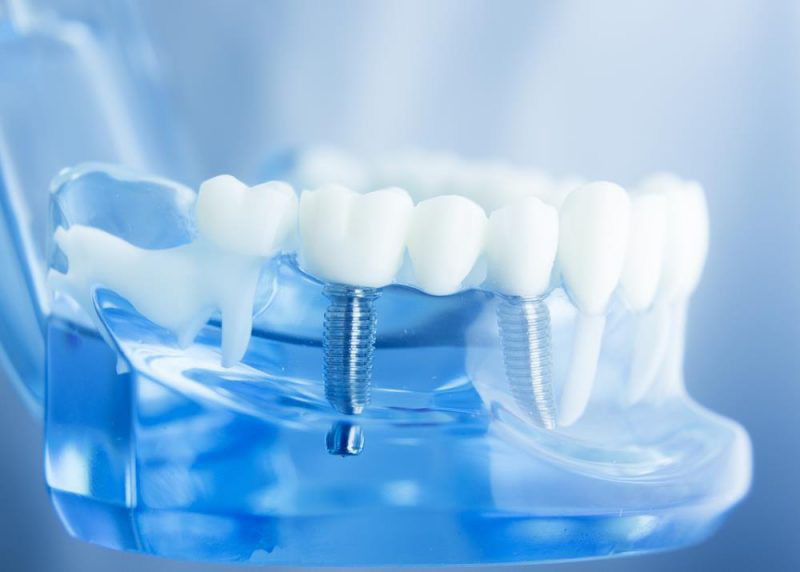 Implante dentário na zona leste